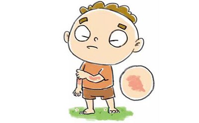 高压氧 VS 银屑病