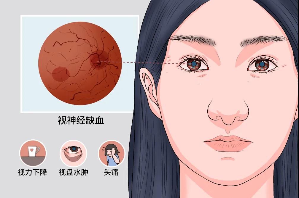 缺血性视神经病变，该试试高压氧了